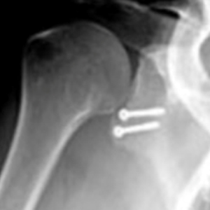 Glenoid Fracture (ORIF)