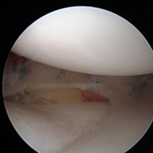 Meniscus repair Partial meniscectomy