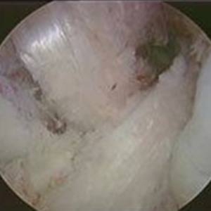 Multi-ligament Knee Reconstruction