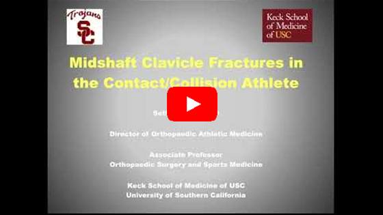 Open Reduction Internal Fixation (ORIF) Clavicle Fracture (Midshaft) Lecture and Surgical Video