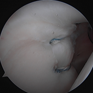 Arthroscopic Superior Labrum Repair (SLAP Repair)