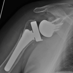 Proximal Humerus Fracture- Reverse Replacement