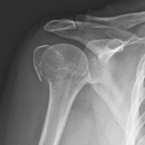 Proximal Humerus Fracture (ORIF)