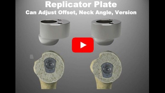 Reverse Replacement/Reverse Shoulder Arthroplasty: Exactech Preserve Stem/Small Glenoid Baseplate