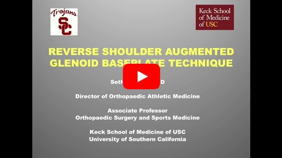 Reverse Shoulder Replacement. Augmented Baseplate Preparation