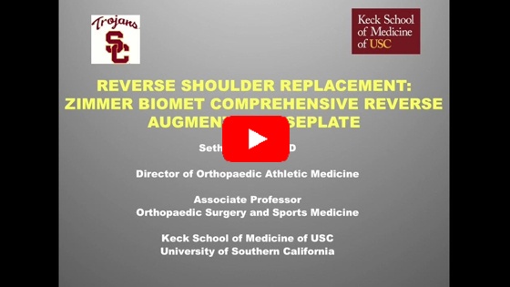 Reverse Total Shoulder Replacement Using Zimmer Biomet Reverse and Augmented Glenoid Baseplate.