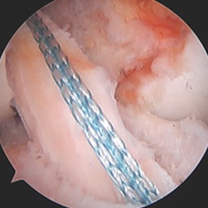 Revision ACL Reconstuction