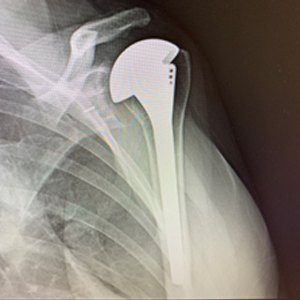 Reverse Shoulder Replacement