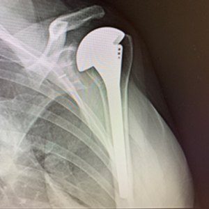 Revision Shoulder Replacement