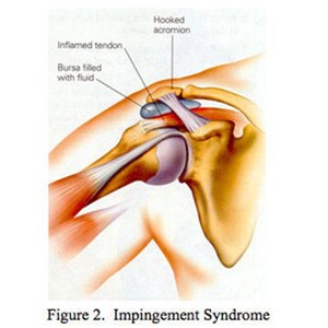 Shoulder Impingement Syndrome