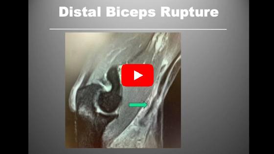 Single Incision Distal Biceps Repair With Suture Anchors, Pulley Technique