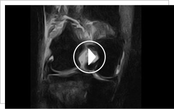 Anatomic BTB Autograft ACL Reconstruction