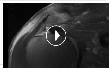 Arthroscopic Double Row Rotator Cuff Repair