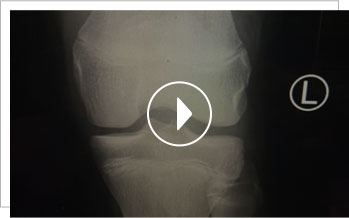 Pediatric ACL Reconstruction