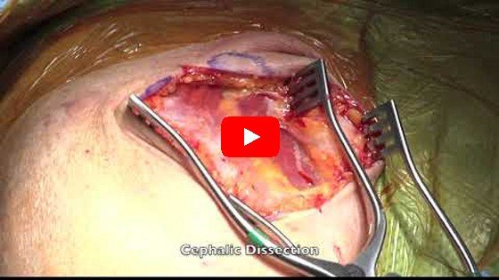 Total Shoulder Arthroplasty: Surgical Demonstration, Zimmer Biomet Comprehensive Shoulder System